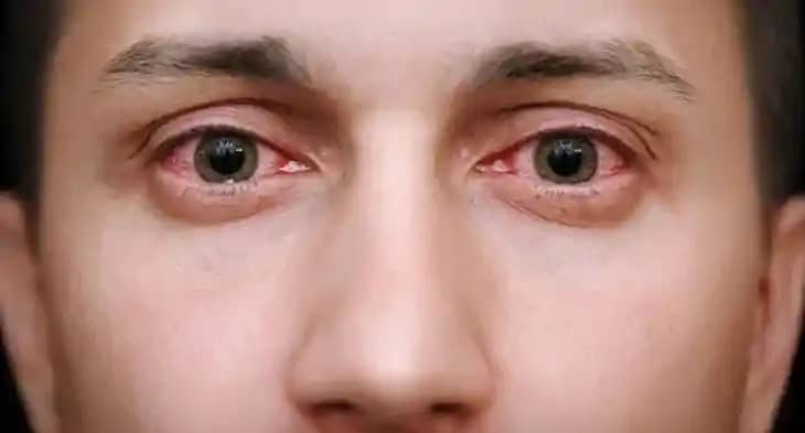 Burning eyes causes Burning eyes causes