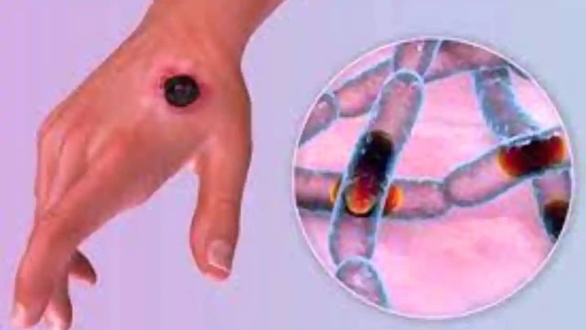 Anthrax disease Anthrax disease